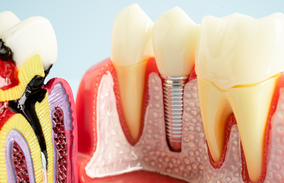 Dental Implants