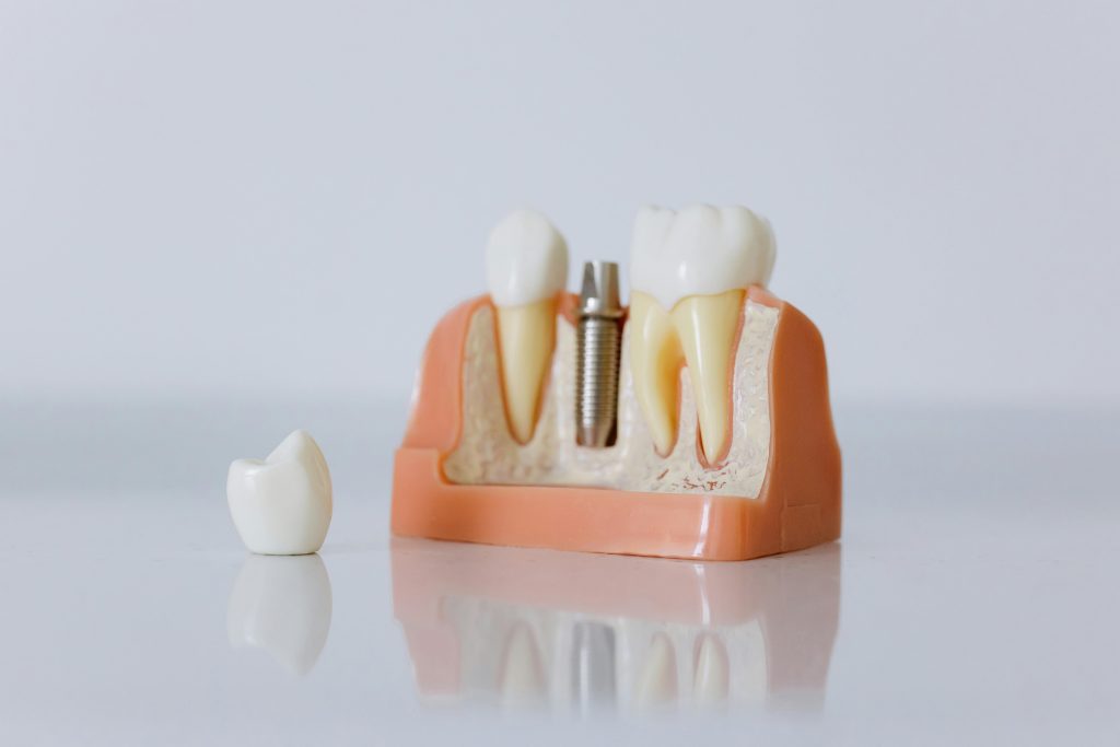 Dental Implants Mississauga